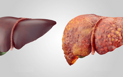 Infographic: Bạn đã biết các dấu hiệu cảnh báo xơ gan?
