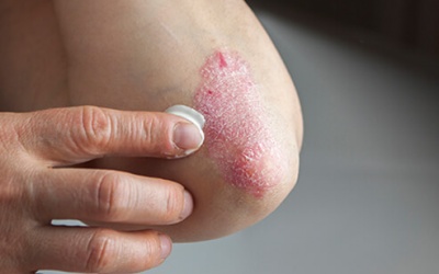 Người bệnh vẩy nến cần chú ý đến 6 thành phần này!