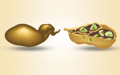 Bạn có biết các biện pháp loại bỏ sỏi mật một cách tự nhiên?