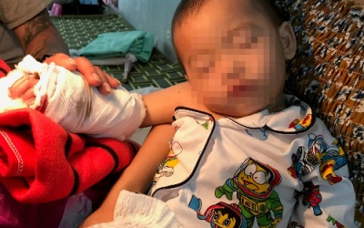 Bàn tay dập nát của bé trai bị thang cuốn kẹp được nối vi phẫu