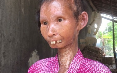 Chuyên gia nói gì về người phụ nữ xinh đẹp 34 tuổi thành bà lão nặng 24kg