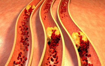 Cách giảm cholesterol đơn giản từ bột yến mạch và hạnh nhân