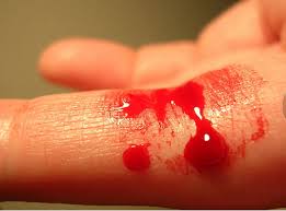 Các biện pháp phòng ngừa hemophilia nặng lên