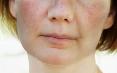 8 điều cần biết về bệnh lupus