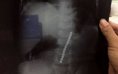 Bất ngờ với chuỗi 13 hạt nam châm trong dạ dày bé trai 2 tuổi