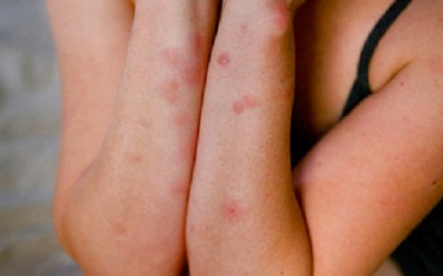 Đừng để những chuyến du lịch của bạn bị phá hỏng vì rệp giường