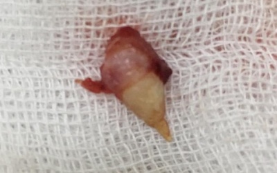 Hy hữu: Răng mọc trong mũi của bé gái 4 tuổi