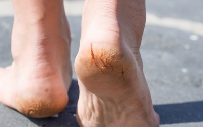 5 nguyên nhân gây bong tróc da chân trong mùa Hè