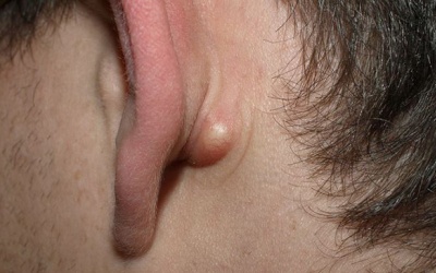 Mọc mụn, u ở tai nguy hiểm như thế nào?