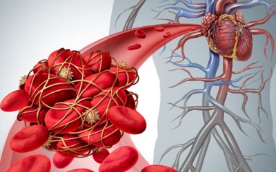 Mối liên hệ giữa cục máu đông và vi khuẩn đường ruột