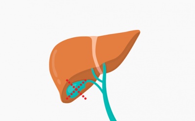 Viêm tụy cấp do sỏi mật: Liệu có cần cắt bỏ túi mật?
