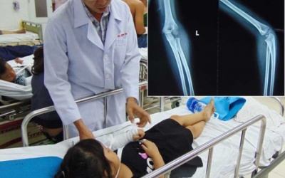 Bó thuốc Nam, coi chừng tay trẻ bị biến dạng