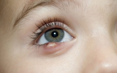 5 biện pháp tự nhiên giúp khắc phục mắt bị lẹo