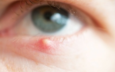Mí mắt nổi mụn đỏ, đau, ngứa ngáy là bệnh gì?