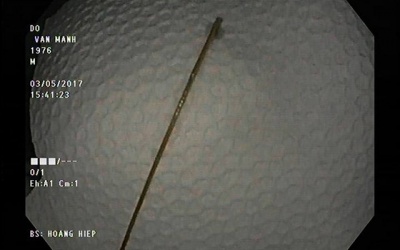 Tưởng đau dạ dày hoá tăm nhọn “ngự” lâu năm không biết