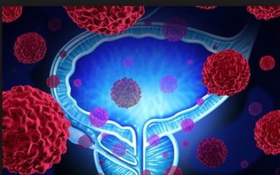 Đâu là các nguy cơ gây ung thư bàng quang?