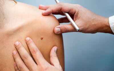 Cẩn trọng với nắng Hè: Quy tắc ABCDE nhận diện ung thư da