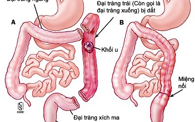 [Inforgraphics]: Phòng ngừa ung thư đại trực tràng hiệu quả