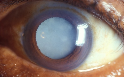 Đục thủy tinh thể do thuốc corticoid phải làm sao?