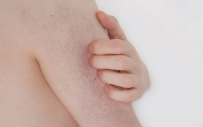 Da sần sùi, khô ráp: Có thể bạn đang mắc dày sừng nang lông