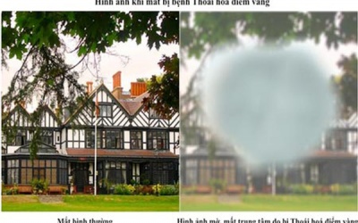 5 nguyên nhân thường gặp gây bệnh về võng mạc