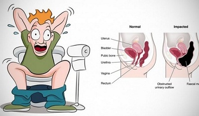 Điều gì xảy ra khi bạn nhịn đại tiện?