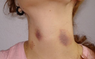 Nốt xuất huyết dưới da có nguy hiểm không?