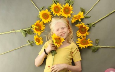 8 sự thật có thể bạn chưa biết về bệnh bạch tạng