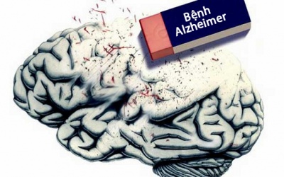 Bệnh Alzheimer gây ra ảnh hưởng gì tới não bộ?
