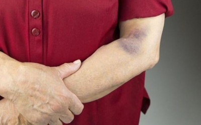 Tiểu cầu giảm dưới 150 G/l có nguy hiểm?