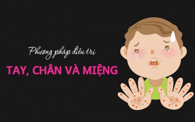 17 phương pháp điều trị tay chân miệng tự nhiên