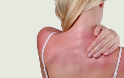 Hạ chí đã tới: Cần đề phòng ngộ độc nắng