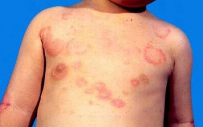 Triệu chứng và nguyên nhân gây xuất huyết giảm tiểu cầu vô căn