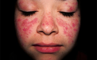Mắc lupus ban đỏ có nên ăn thịt chim bồ câu?