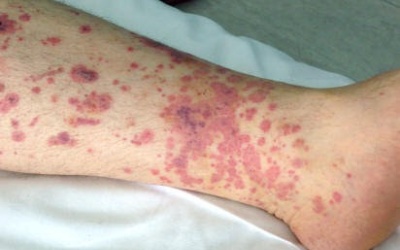 Chẩn đoán xuất huyết giảm tiểu cầu vô căn cần những xét nghiệm nào?