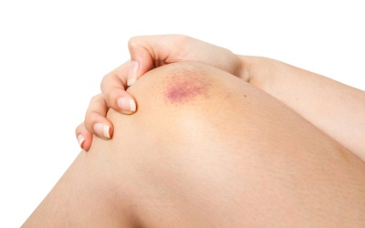 Những điều cần biết về xuất huyết dưới da