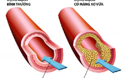 3 loại acid amin giúp làm sạch động mạch, giảm xơ vữa động mạch