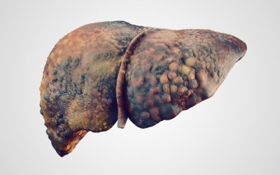 Đâu là các biện pháp giúp kiểm soát bệnh xơ gan ứ mật?