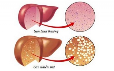 Làm sao để điều trị gan nhiễm mỡ không do rượu?