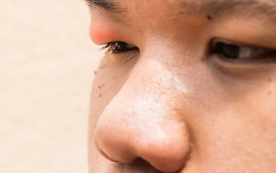 12 nguyên nhân khiến mí mắt bị sưng