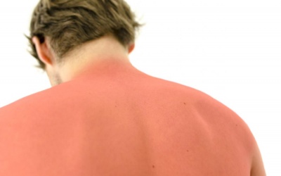 Bổ sung vitamin D có thể giúp cải thiện tình trạng cháy nắng