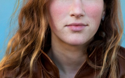 11 dấu hiệu cho thấy bạn có thể bị lupus ban đỏ