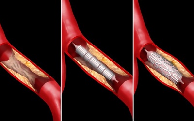Các biến chứng thường gặp sau khi đặt stent mạch vành