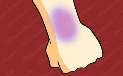 Bé hay bị bầm tím có phải do thiếu vitamin?