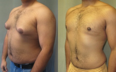 Nguyên nhân khiến đàn ông có ngực to như phụ nữ