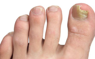 Mưa bão ngập lụt bị nấm chân, chữa thế nào?