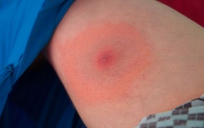 4 biện pháp tự nhiên giúp phòng tránh và điều trị bệnh Lyme hiệu quả