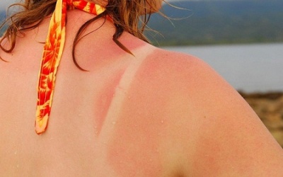 Vitamin D có thể làm dịu cơn cháy nắng