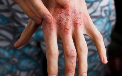 3 cách sử dụng giấm táo để điều trị eczema