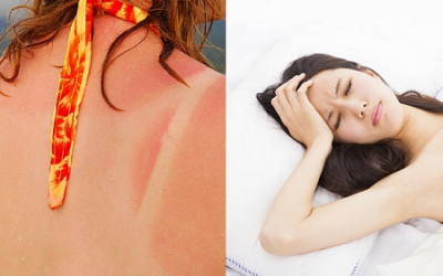 5 dấu hiệu cho thấy bạn đang bị 'ngộ độc nắng'